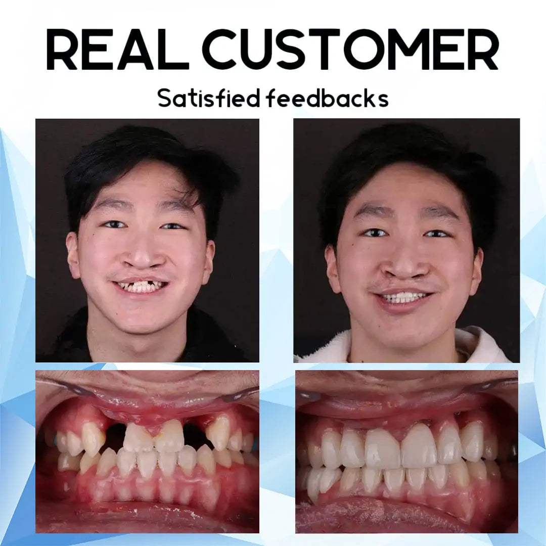 Cosmetic Denture Prosthesis for Adults, Removable Silicone Tooth Filling, Reusable, Natural White | Sansoti