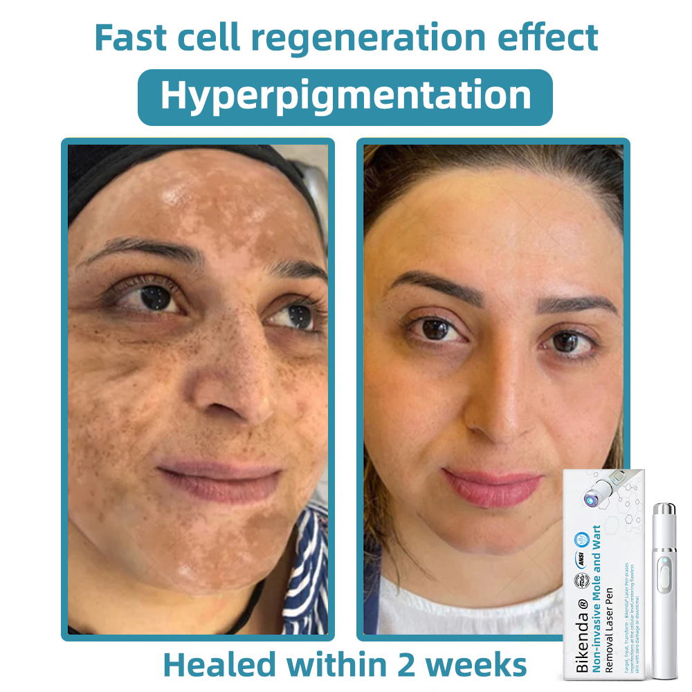 Präzisionsstift für Hautpflege CO₂-Technologie Für den Heimgebrauch Anti-Aging Hautverbesserung Skin-Care-Tool | Sansoti