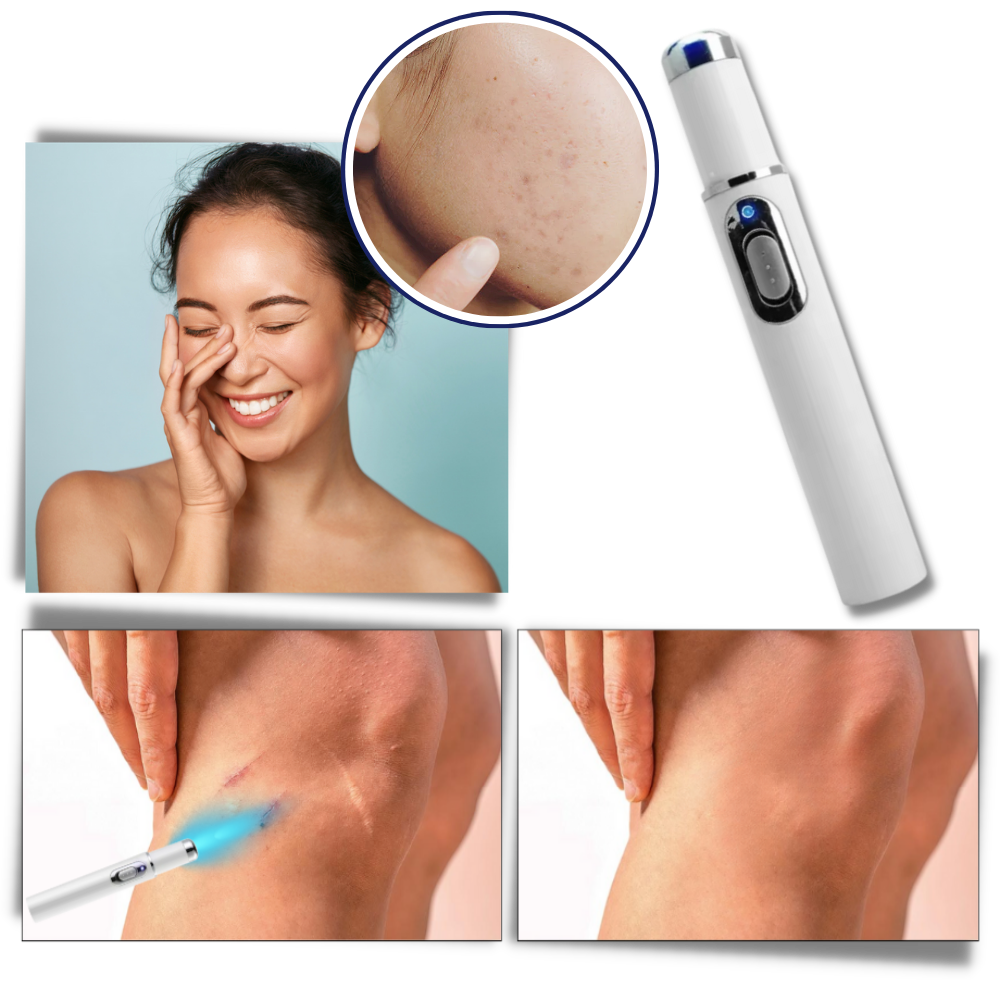 Huidverzorgingspen met Blauwe Lichttherapie tegen Pigmentvlekken en Littekens | Draagbaar Huidverjonging Apparaat voor Thuisgebruik | Precisie Laserbehandeling Hyperpigmentatie Vermindering Anti-Aging | Sansoti