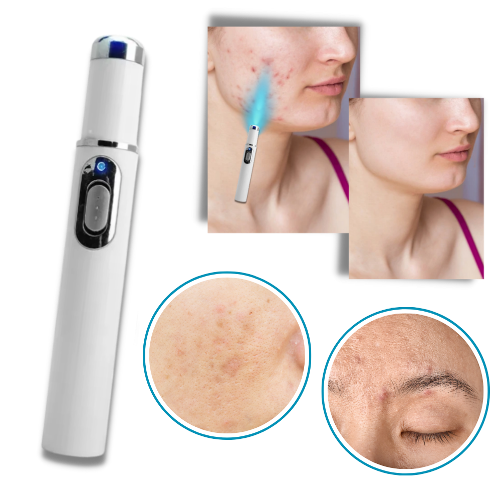Huidverzorgingspen met Blauwe Lichttherapie tegen Pigmentvlekken en Littekens | Draagbaar Huidverjonging Apparaat voor Thuisgebruik | Precisie Laserbehandeling Hyperpigmentatie Vermindering Anti-Aging | Sansoti