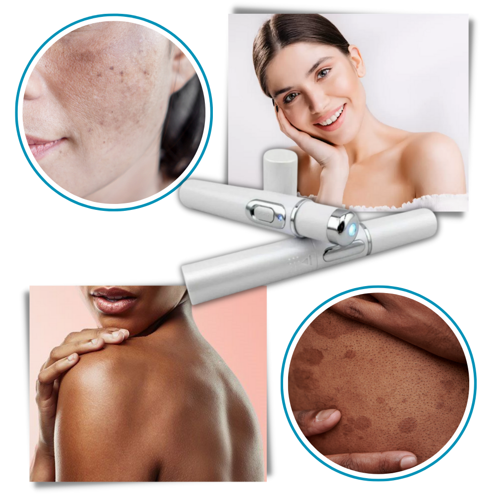 Huidverzorgingspen met Blauwe Lichttherapie tegen Pigmentvlekken en Littekens | Draagbaar Huidverjonging Apparaat voor Thuisgebruik | Precisie Laserbehandeling Hyperpigmentatie Vermindering Anti-Aging | Sansoti