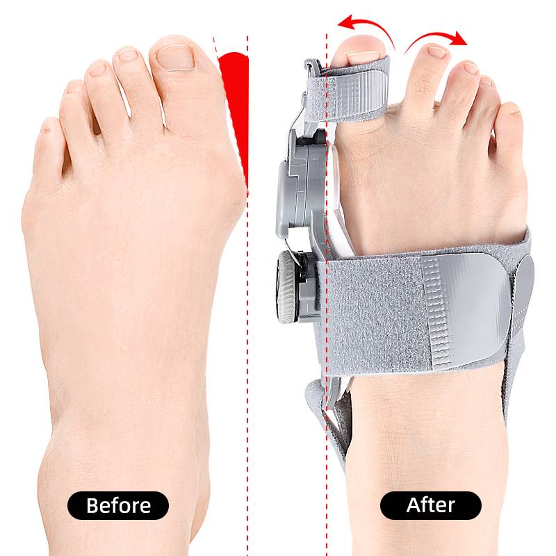 Correcteur d’orteil avec pression réglable pour le traitement de l’hallux valgus, confortable de jour comme de nuit, orthopédique | Sansoti