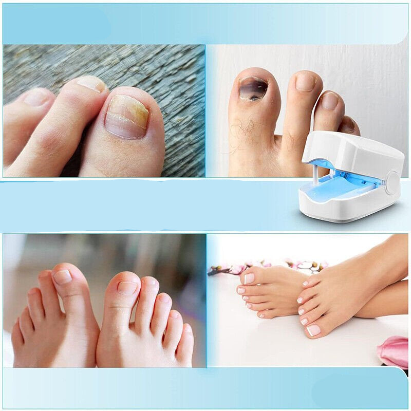 Lichttherapie Apparaat 910nm tegen Nagelschimmel Oplaadbaar USB Thuisbehandeling voor Gezonde Nagels | Sansoti