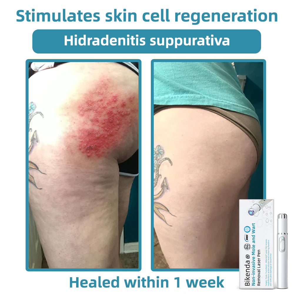 Precisiepen voor Huidverzorging CO₂ Technologie Thuisgebruik Anti-Aging Huidverbetering Skin Care Tool | Sansoti