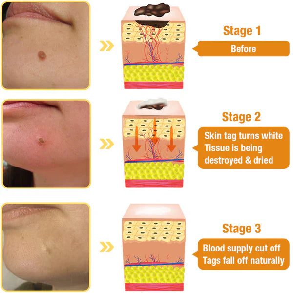 Bee Venom Spray for Skin Growth – Natural Removal of Skin Tags, Warts, and Moles | Sansoti