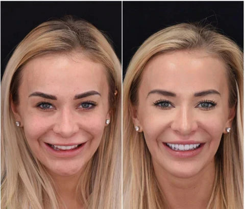 Cosmetische Tandfacet Set Boven & Onder Verstelbaar Vormbaar Herbruikbaar Natuurlijk Wit Instant Smile | Sansoti