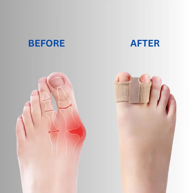 Teenspreiderset Siliconen voor Hallux Valgus en Overlappende Tenen – Zachte Correctie & Pijnverlichting | Sansoti
