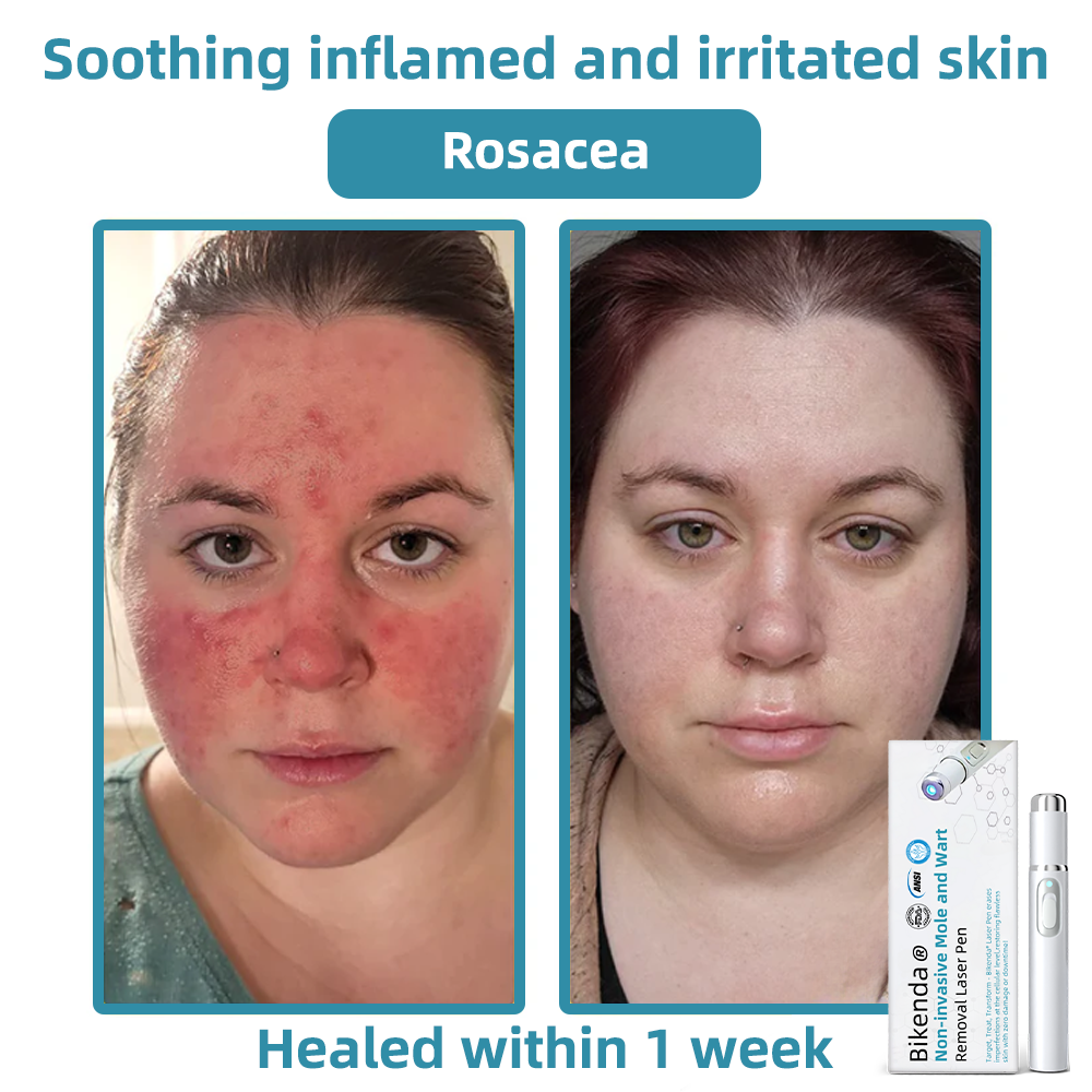 Precisiepen voor Huidverzorging CO₂ Technologie Thuisgebruik Anti-Aging Huidverbetering Skin Care Tool | Sansoti