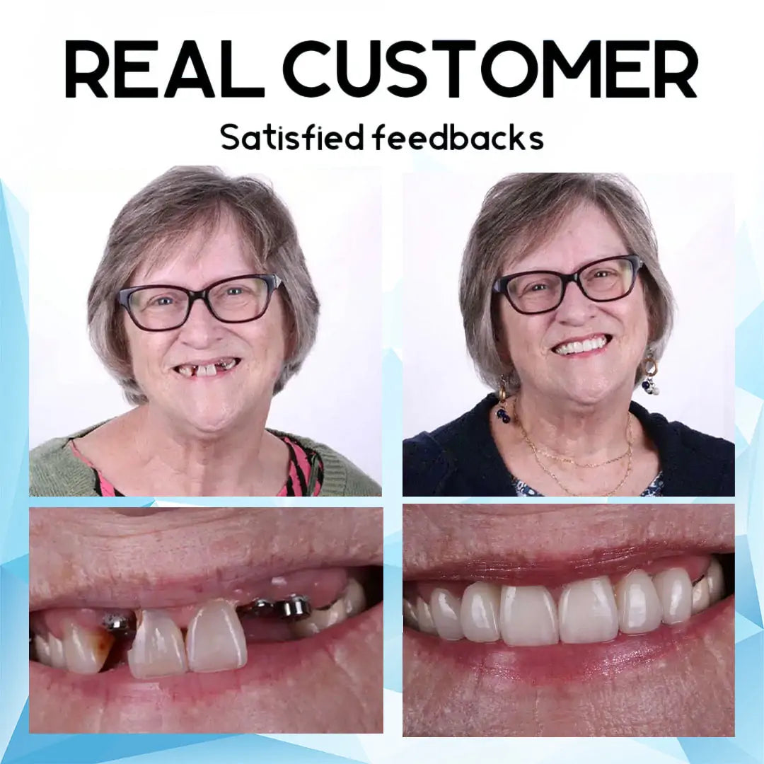 Cosmetic Denture Prosthesis for Adults, Removable Silicone Tooth Filling, Reusable, Natural White | Sansoti