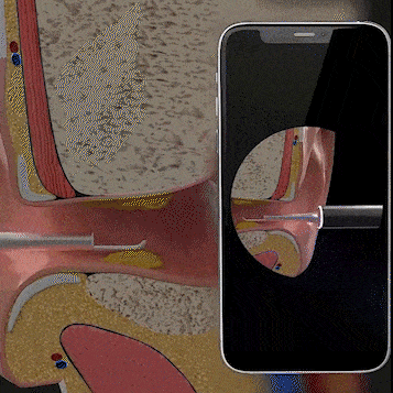 Ear Exam Camera with Silicone Cleaning Attachment and LED Lighting | Sansoti